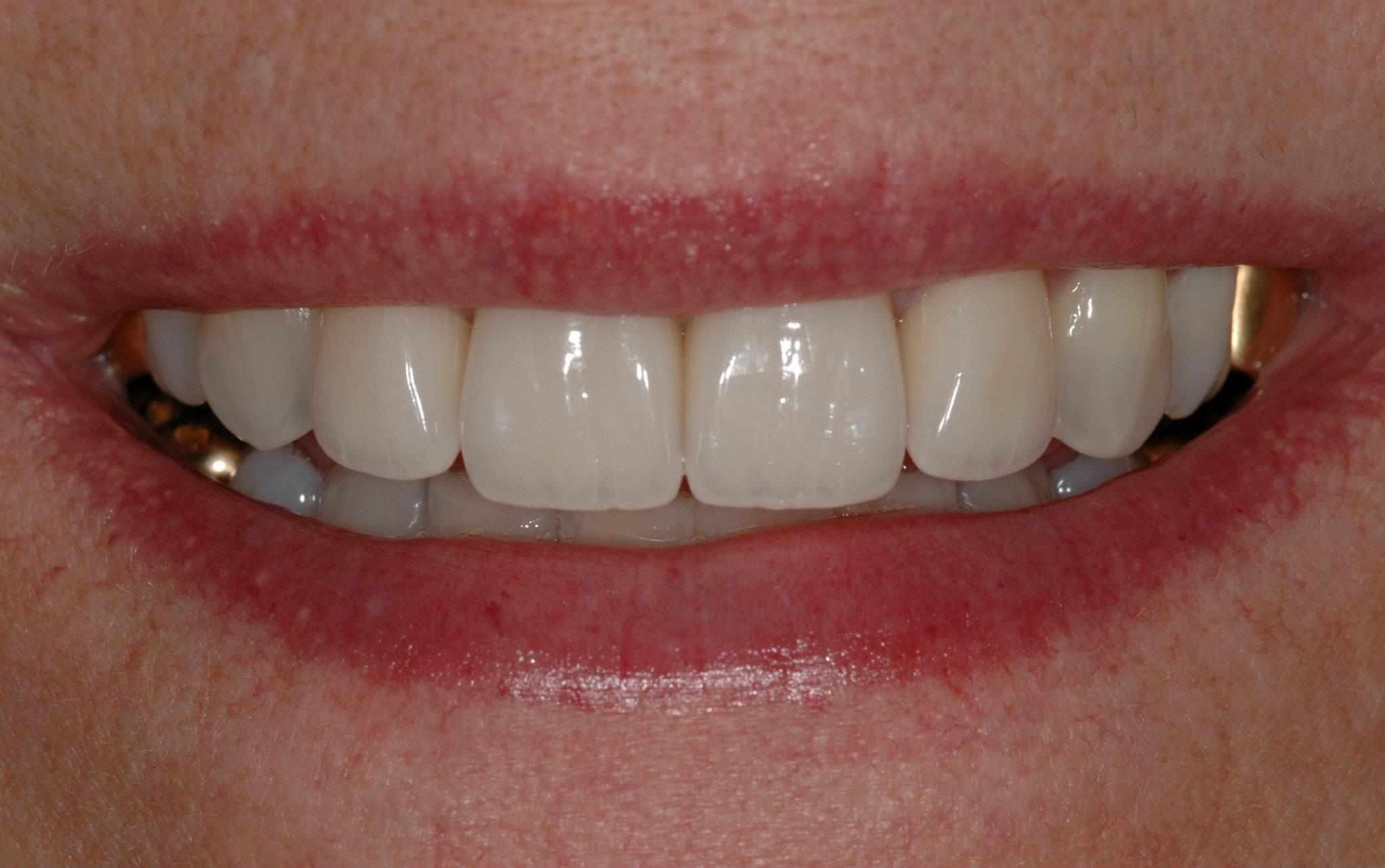 Porcelain Veneers Spear Aesthetics in Seattle, WA